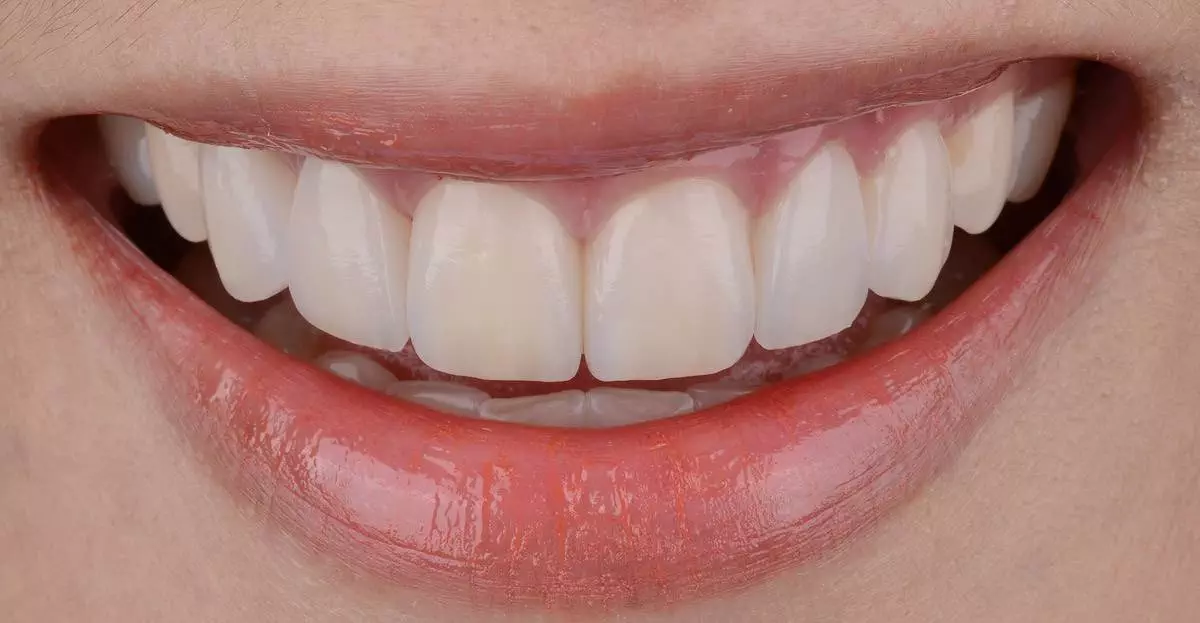 Invisalign after 01