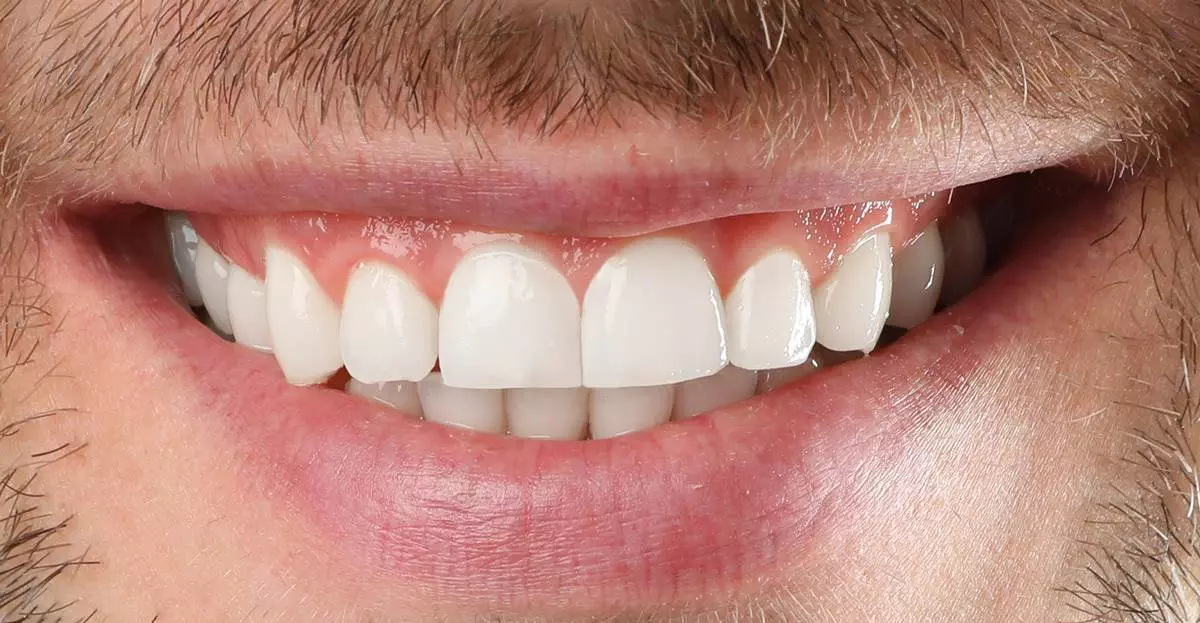 Invisalign after 02