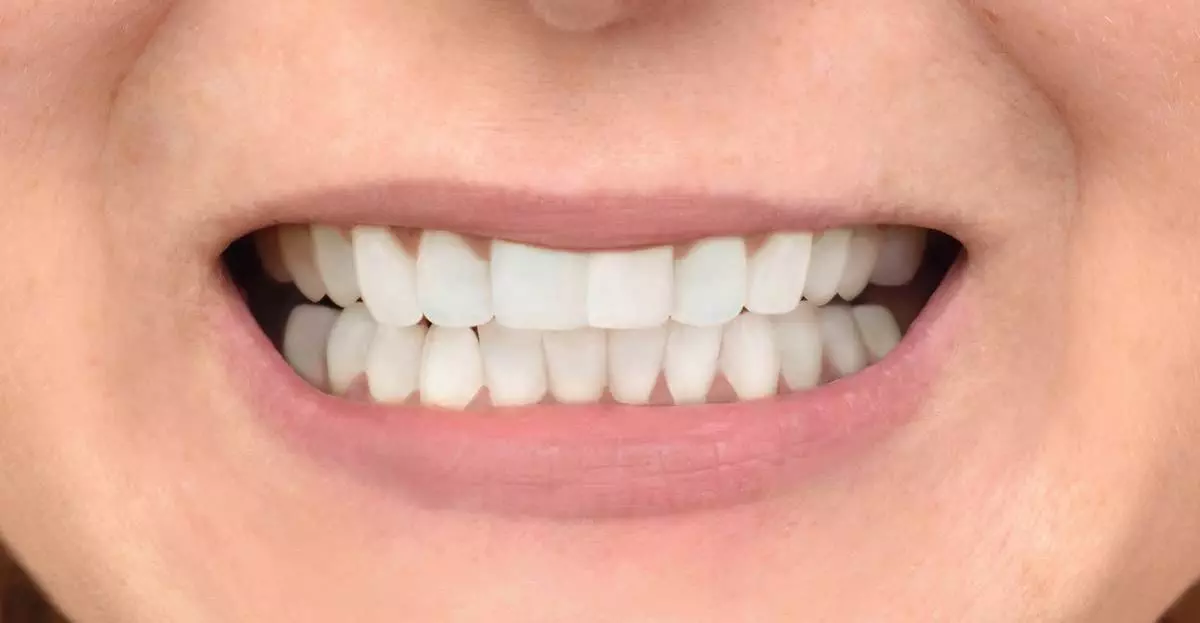 Invisalign after 03