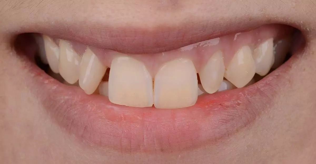 Invisalign before 01