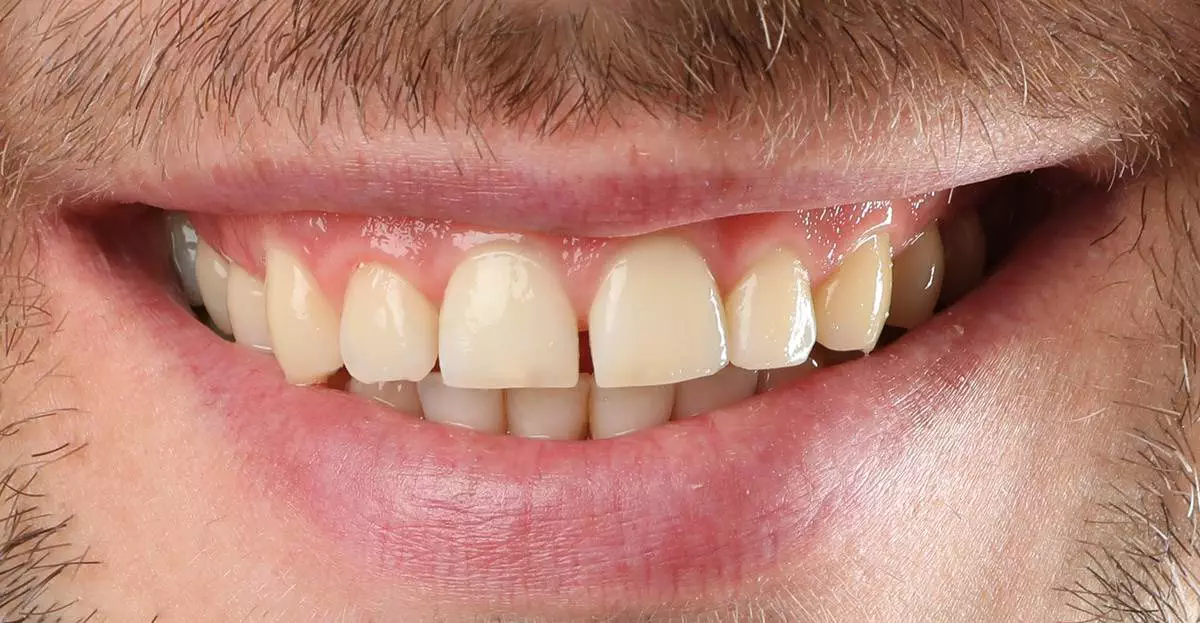 Invisalign before 02