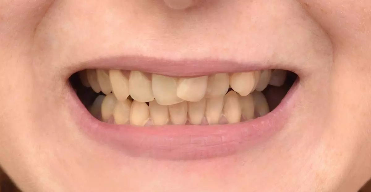 Invisalign before 03